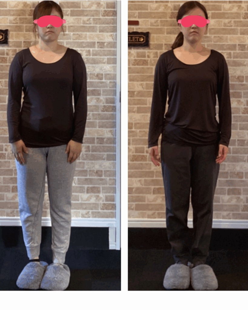 富士市整体｜美容矯正サロンリバース｜ブライダル矯正｜ビフォーアフター｜ブログ｜20代｜