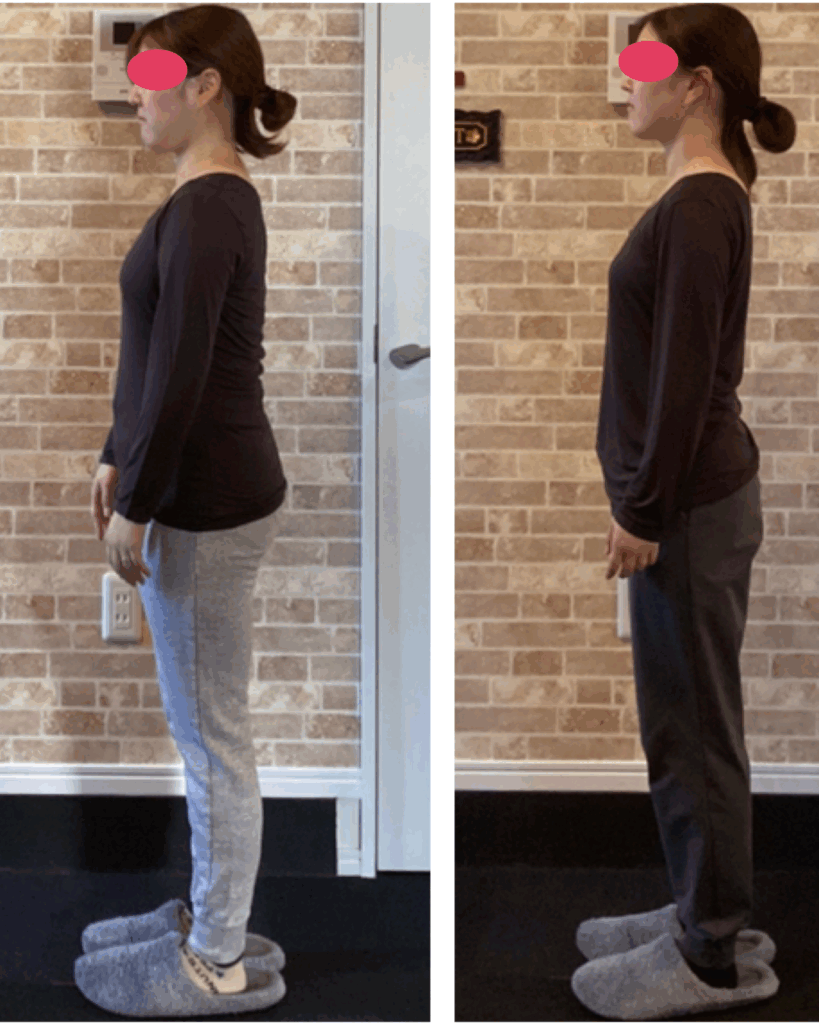 富士市整体｜ブライダル矯正｜リバース｜ブログ｜ビフォーアフター｜横向き