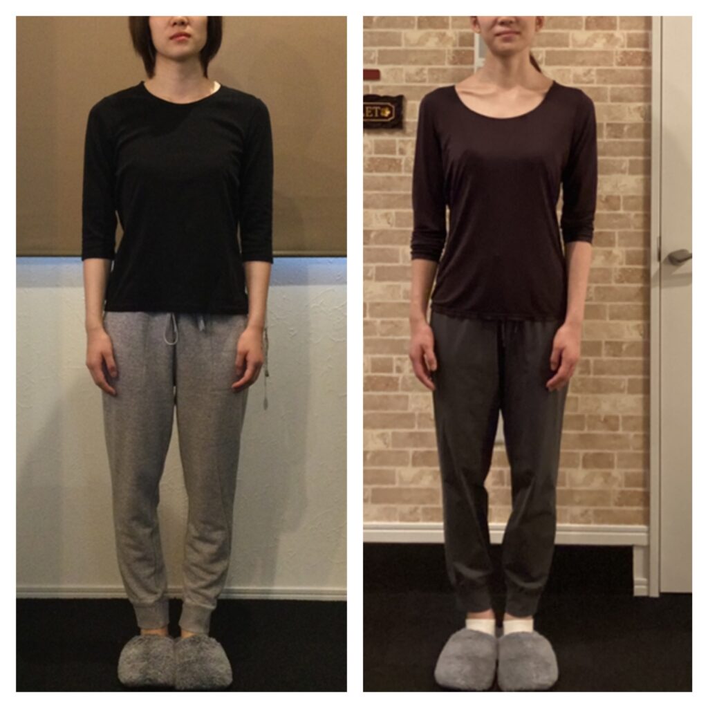 富士市整体｜ビフォーアフター｜リバース｜ブライダル矯正｜３年の定期メンテ｜積み重ね｜正面