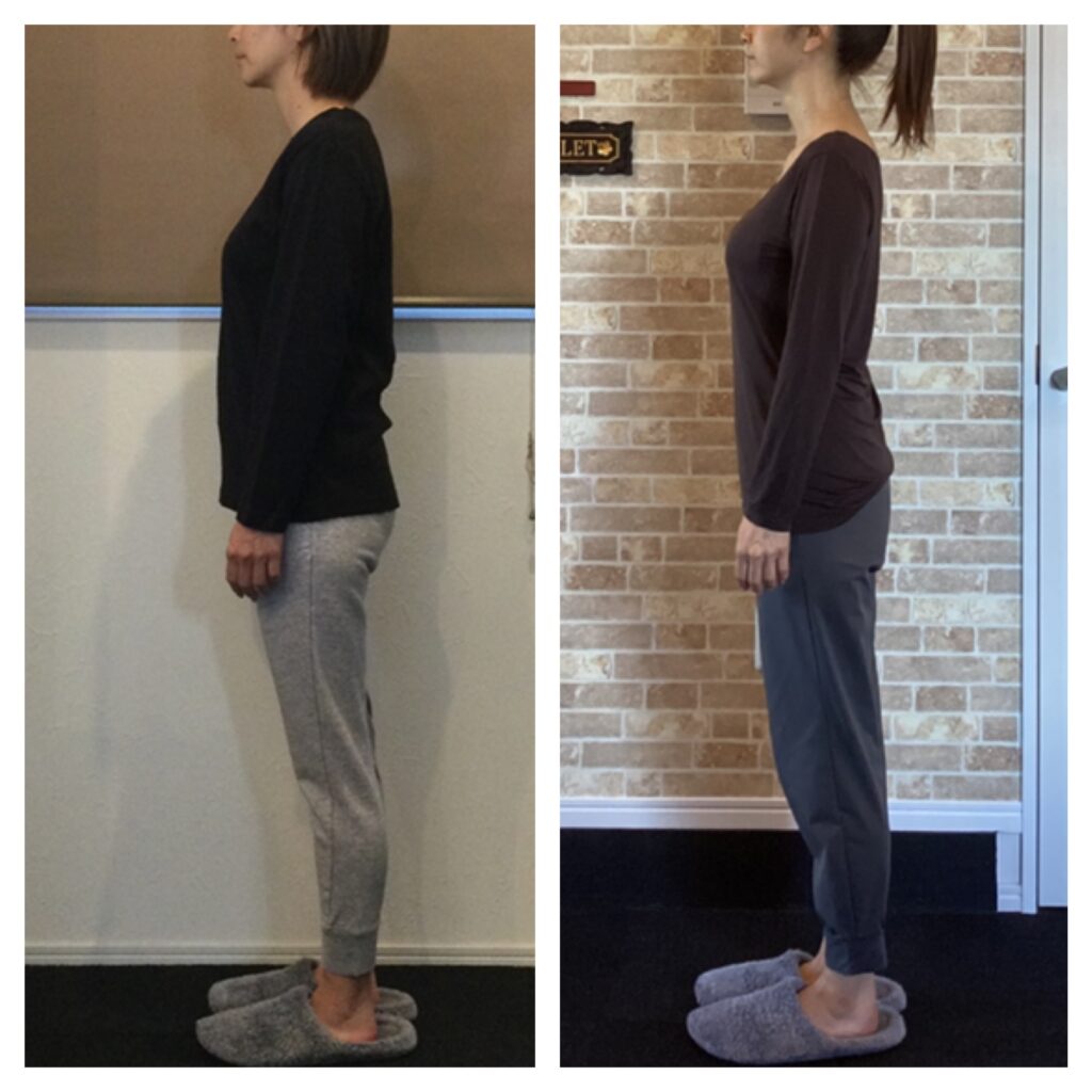 富士市整体｜美容矯正｜リバース｜ビフォーアフター｜ブログ｜４０代｜アンチエイジング｜横向き