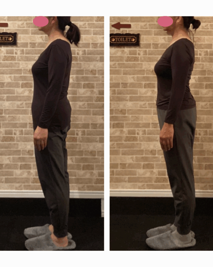 富士市整体｜リバース｜美容矯正｜姿勢矯正｜ビフォーアフター｜50代後半｜横向き｜