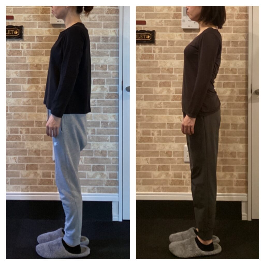 富士市の整体美容矯正サロンリバースのホームページの「ビフォーアフター(最新版)」の、【ブライダル矯正/20代/月２回　５ヶ月】の写真