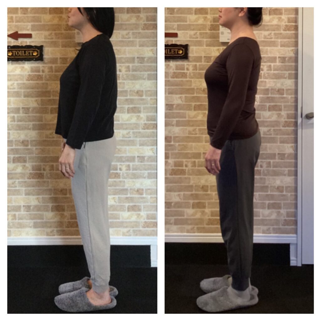 富士市の整体 Re・birth で姿勢矯正を受けた49歳女性のビフォーアフター写真。猫背・巻き肩・首のもっこりが改善し、骨盤が立ち、美しい姿勢とヒップアップが実現。