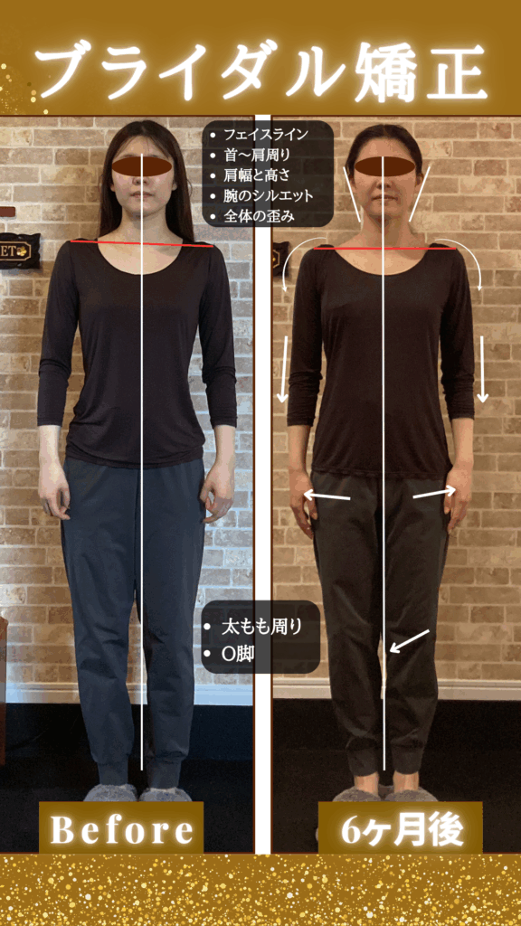 富士市の整体Re・birthでブライダル矯正を受けた20代女性。首・肩こり、O脚、体の歪みが改善し、美しい姿勢に整ったビフォーアフター